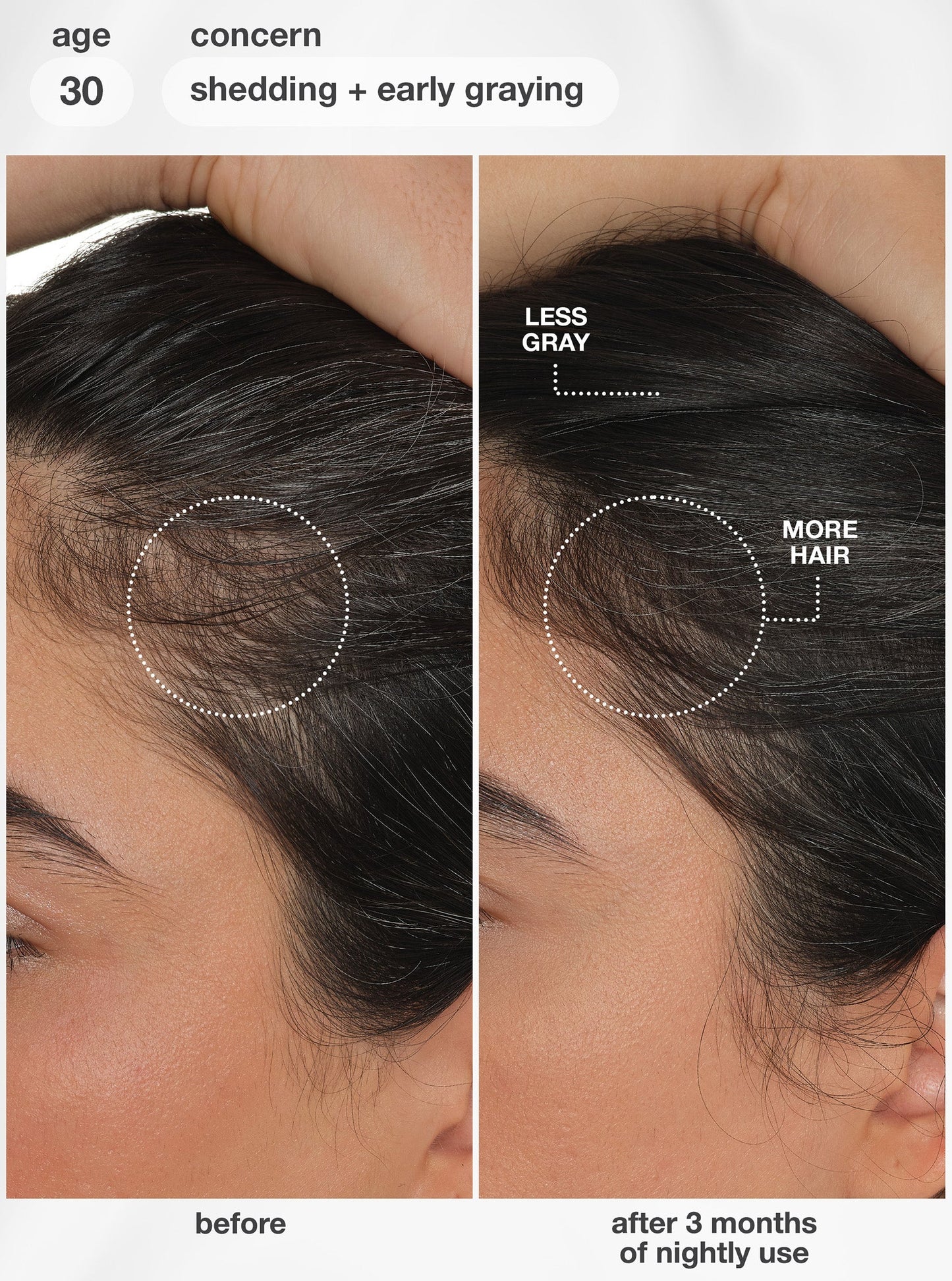 Before and after comparison of hair health with less gray and more hair after 3 months of nightly use.